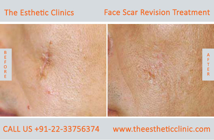 Facial Scars Revision laser Treatment for Face before after photos in mumbai india (4)